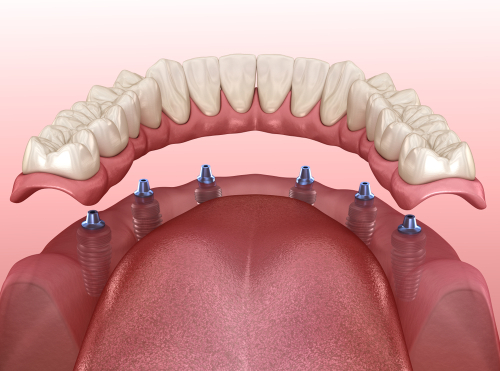 All-on-6 Dental Implants: A Revolutionary Solution for Tooth Loss