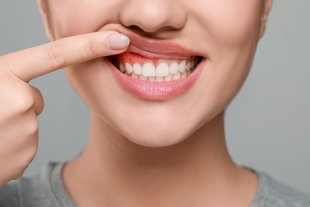 Gum Grafting: Restoring Healthy Gums for a Beautiful Smile